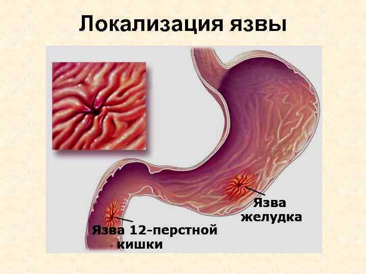 Локализация язвы 