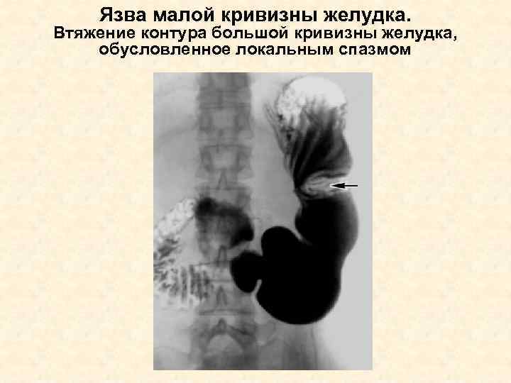 Язва малой кривизны желудка. Втяжение контура большой кривизны желудка, обусловленное локальным спазмом 