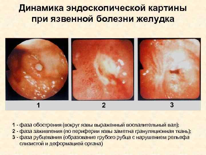 Динамика эндоскопической картины при язвенной болезни желудка 1 - фаза обострения (вокруг язвы выраженный