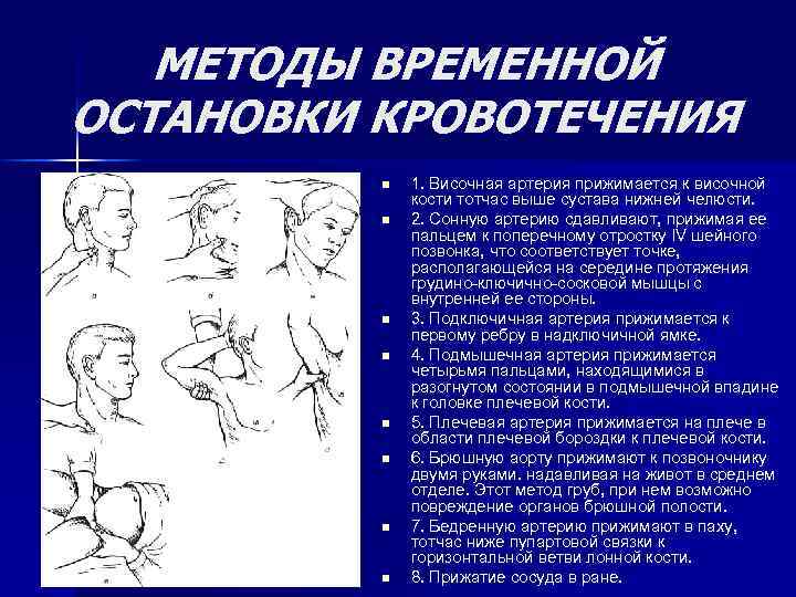 МЕТОДЫ ВРЕМЕННОЙ ОСТАНОВКИ КРОВОТЕЧЕНИЯ n n n n 1. Височная артерия прижимается к височной