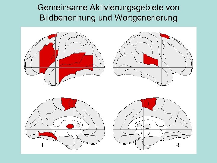 Gemeinsame Aktivierungsgebiete von Bildbenennung und Wortgenerierung 