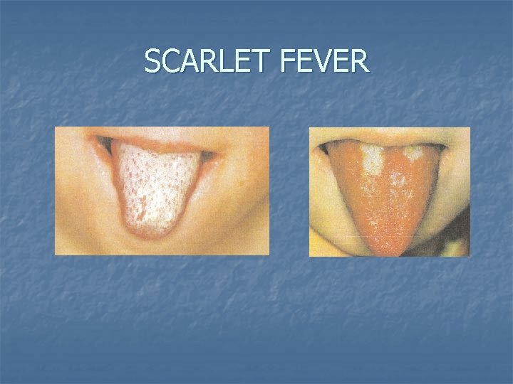 SCARLET FEVER 