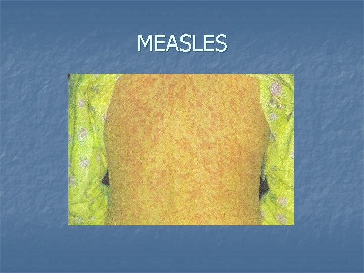 MEASLES 