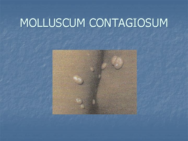 MOLLUSCUM CONTAGIOSUM 