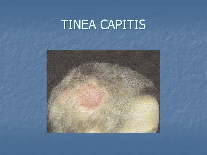 TINEA CAPITIS 