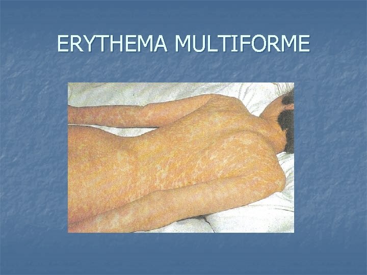 ERYTHEMA MULTIFORME 