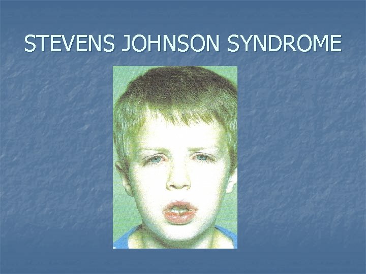 STEVENS JOHNSON SYNDROME 