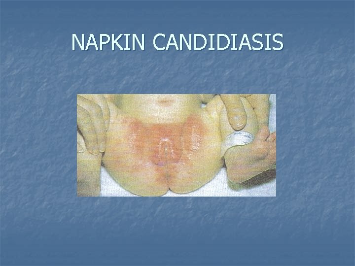 NAPKIN CANDIDIASIS 