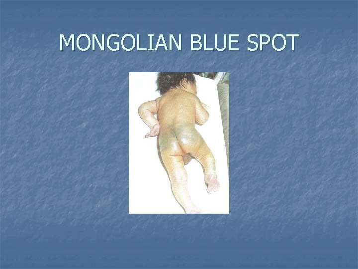 MONGOLIAN BLUE SPOT 