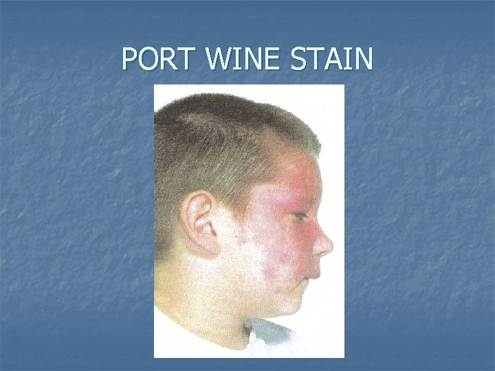 PORT WINE STAIN 