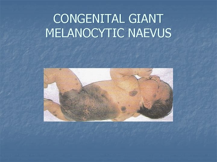 CONGENITAL GIANT MELANOCYTIC NAEVUS 