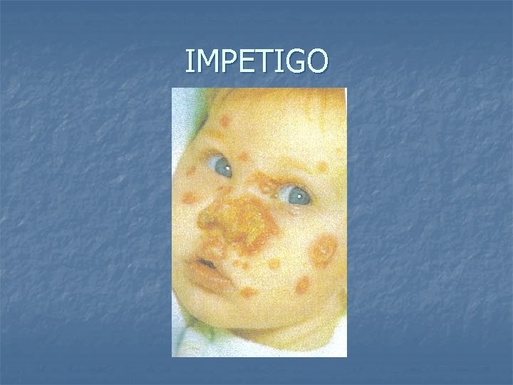IMPETIGO 