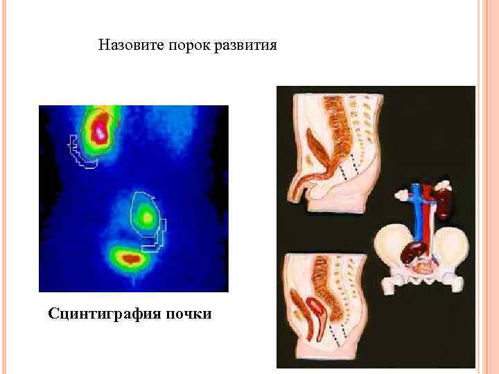 Назовите порок развития Сцинтиграфия почки 