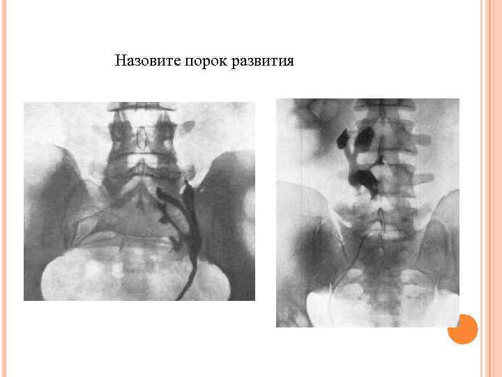 Назовите порок развития 