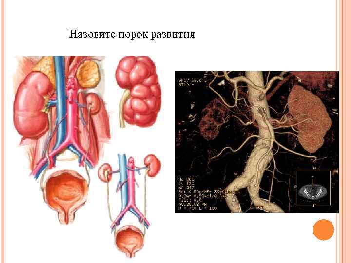 Назовите порок развития 