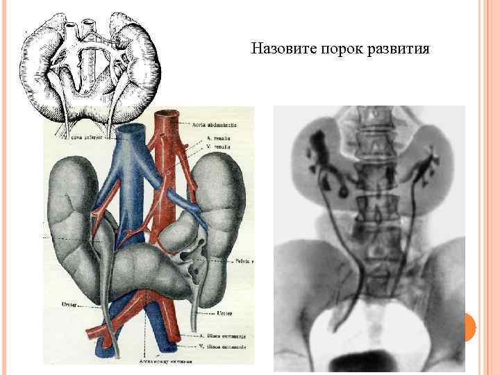 Назовите порок развития 