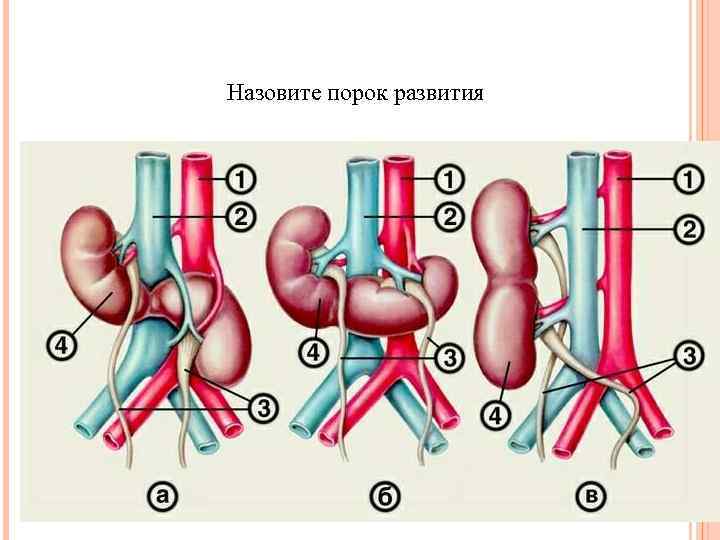 Назовите порок развития 