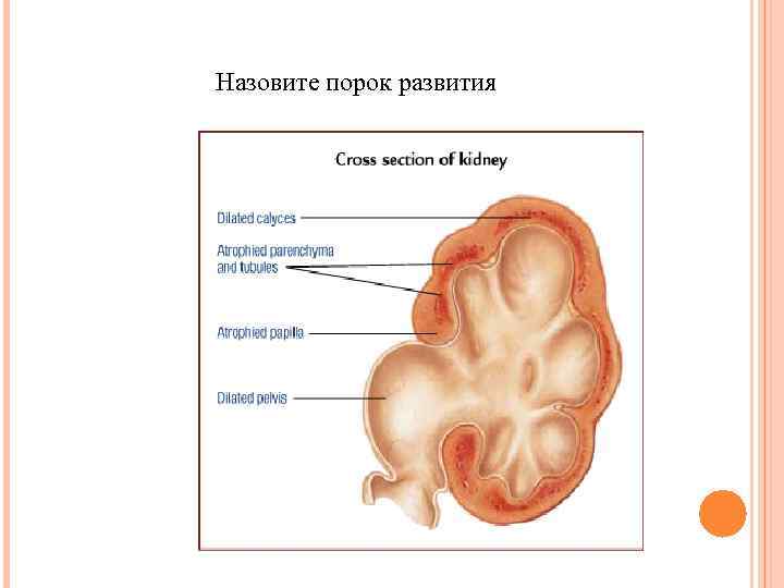 Назовите порок развития 