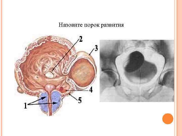 Назовите порок развития 