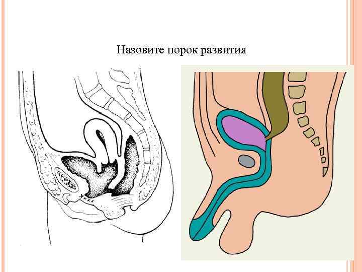 Назовите порок развития 