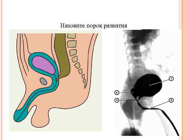 Назовите порок развития 