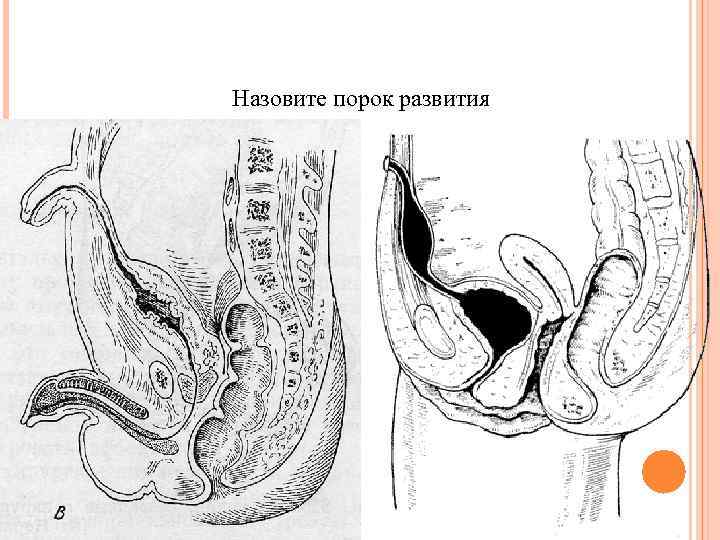 Назовите порок развития 