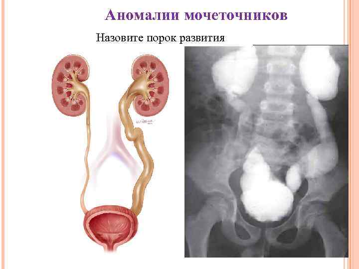 Аномалии мочеточников Назовите порок развития 