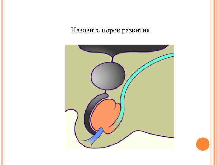 Назовите порок развития 