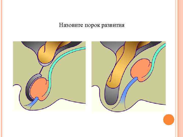 Назовите порок развития 