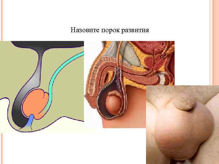 Назовите порок развития 