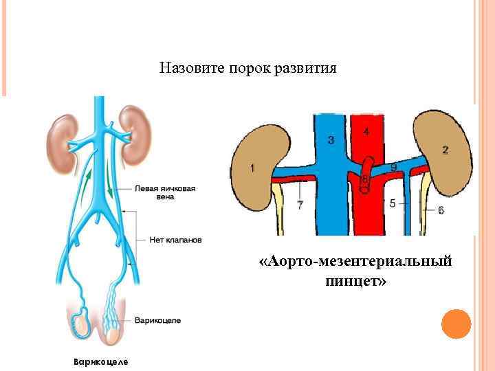 Назовите порок развития «Аорто-мезентериальный пинцет» 