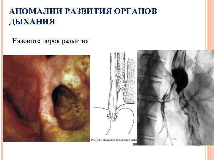 АНОМАЛИИ РАЗВИТИЯ ОРГАНОВ ДЫХАНИЯ Назовите порок развития 