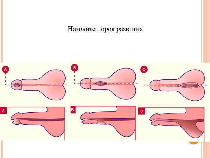 Назовите порок развития 