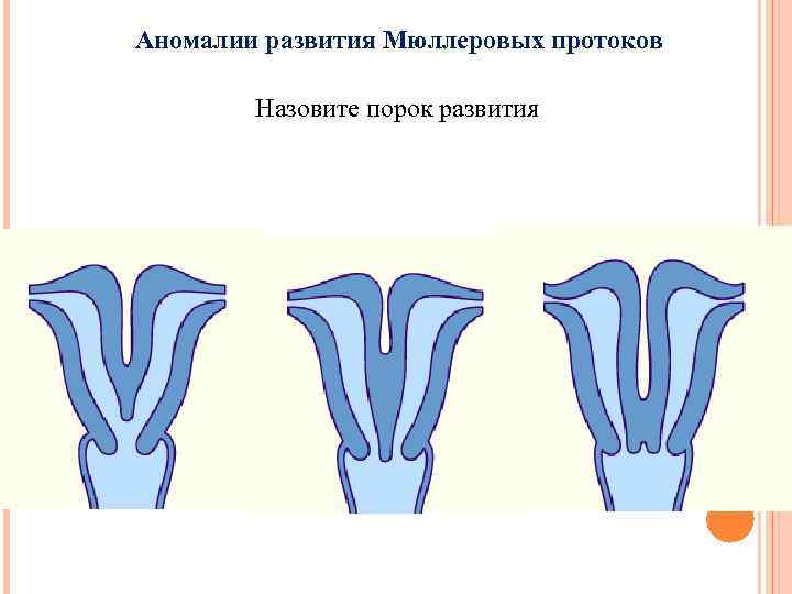 Аномалии развития Мюллеровых протоков Назовите порок развития 