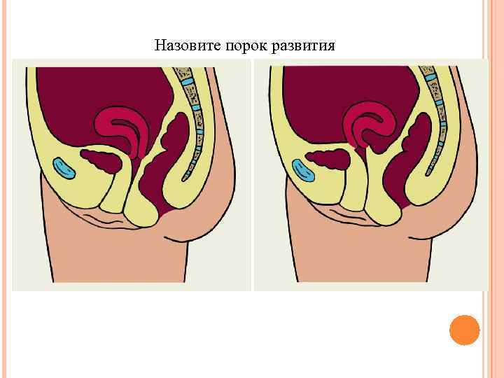 Назовите порок развития 