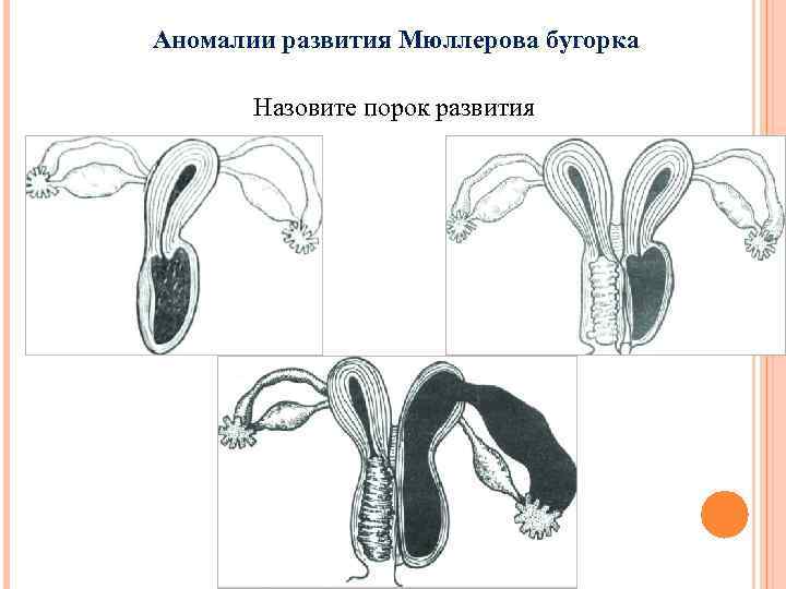 Аномалии развития Мюллерова бугорка Назовите порок развития 