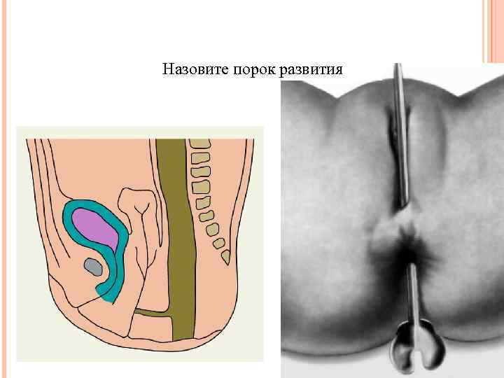 Назовите порок развития 