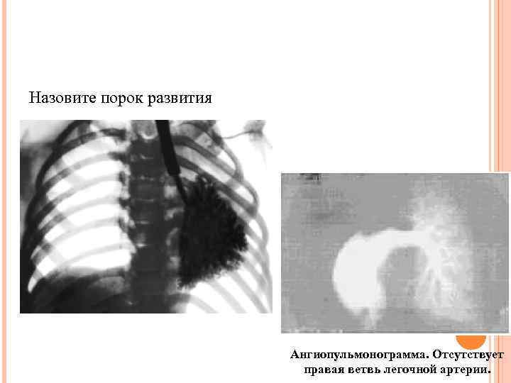 Назовите порок развития Ангиопульмонограмма. Отсутствует правая ветвь легочной артерии. 