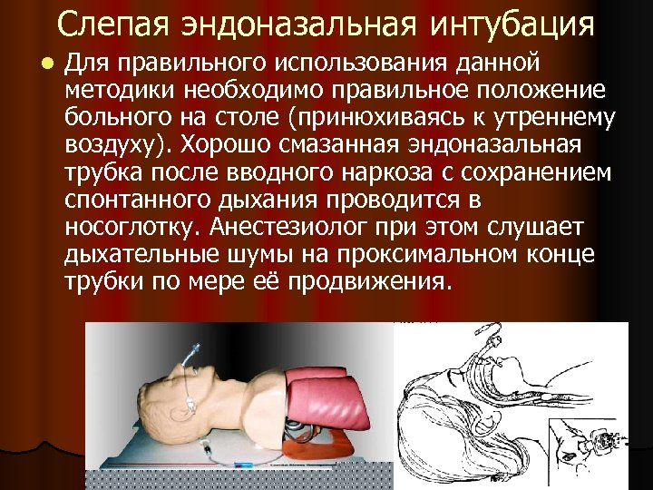 Слепая эндоназальная интубация l Для правильного использования данной методики необходимо правильное положение больного на