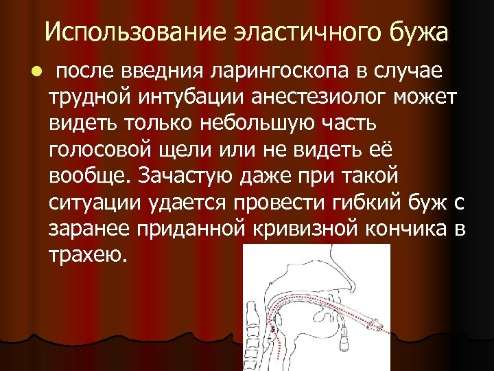 Использование эластичного бужа l после введния ларингоскопа в случае трудной интубации анестезиолог может видеть