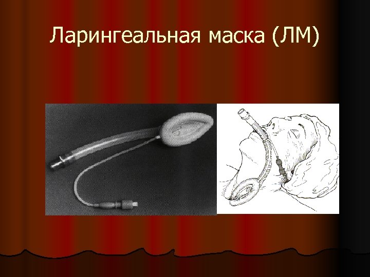 Ларингеальная маска (ЛМ) 