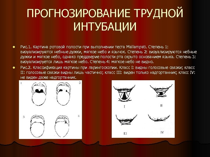 ПРОГНОЗИРОВАНИЕ ТРУДНОЙ ИНТУБАЦИИ l l Рис. 1. Картина ротовой полости при выполнении теста Mallampati.