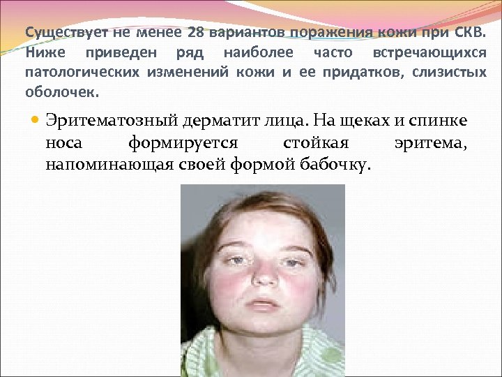 Существует не менее 28 вариантов поражения кожи при СКВ. Ниже приведен ряд наиболее часто