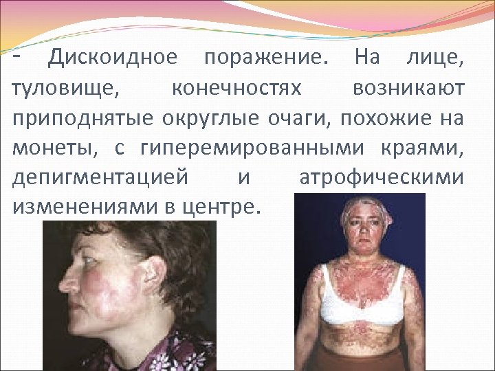 - Дискоидное поражение. На лице, туловище, конечностях возникают приподнятые округлые очаги, похожие на монеты,