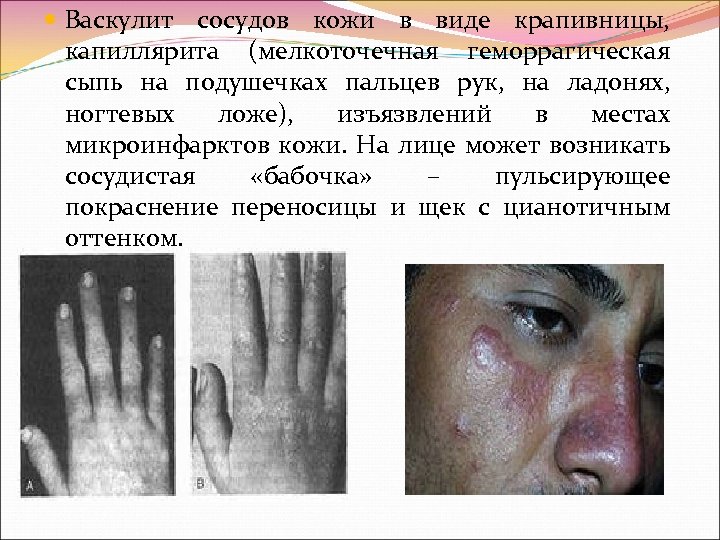  Васкулит сосудов кожи в виде крапивницы, капиллярита (мелкоточечная геморрагическая сыпь на подушечках пальцев