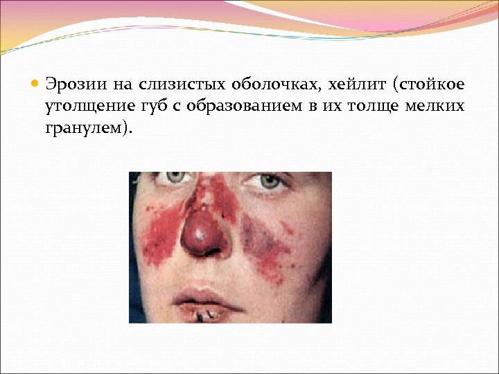  Эрозии на слизистых оболочках, хейлит (стойкое утолщение губ с образованием в их толще