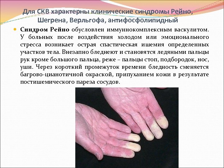 Для СКВ характерны клинические синдромы Рейно, Шегрена, Верльгофа, антифосфолипидный Синдром Рейно обусловлен иммуннокомплексным васкулитом.