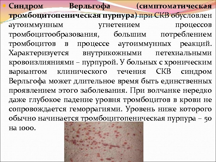  Синдром Верльгофа (симптоматическая тромбоцитопеническая пурпура) при СКВ обусловлен аутоиммунным угнетением процессов тромбоцитообразования, большим