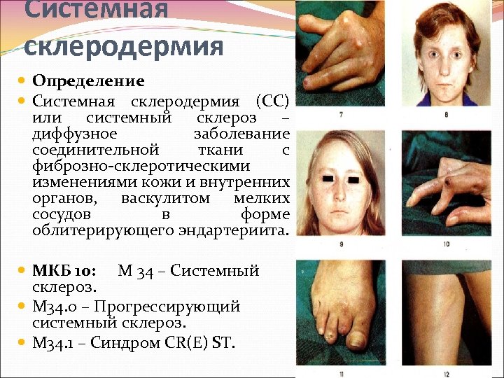 Системная склеродермия Определение Системная склеродермия (СС) или системный склероз – диффузное заболевание соединительной ткани