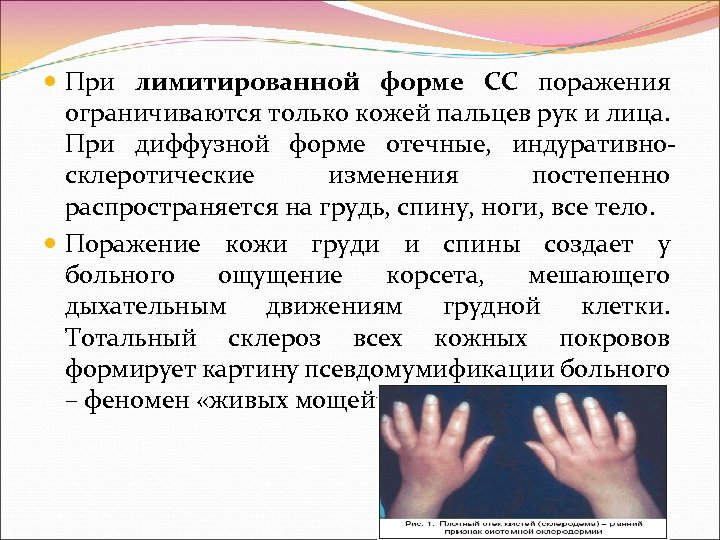  При лимитированной форме СС поражения ограничиваются только кожей пальцев рук и лица. При